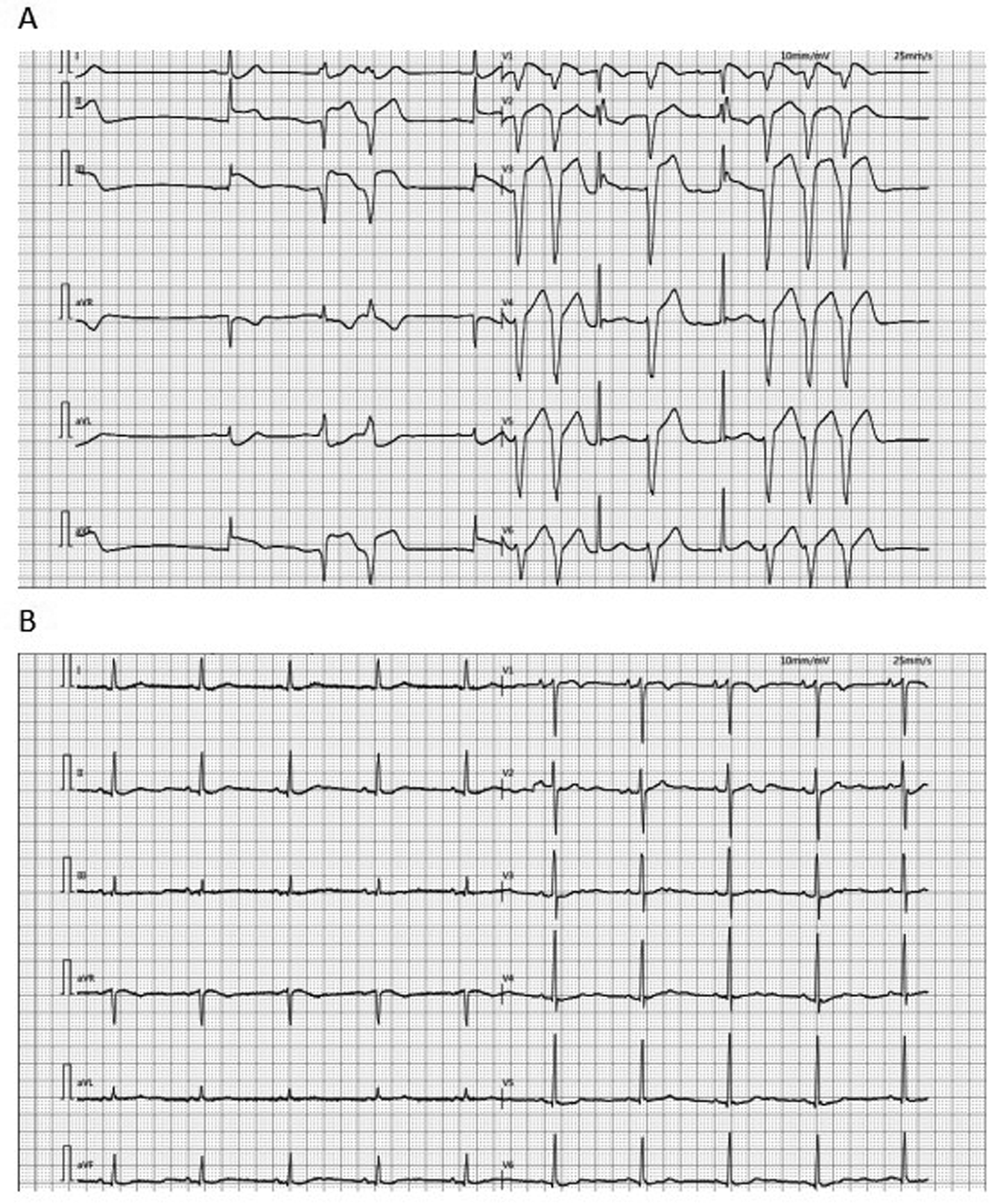(A) The ECG of the patient at admission showed ventricular premature contractions, prolonged QTc and changes in the ST-T segment. (B) The ECG of the patient transferred back to the general ward after the operation showed sinus rhythm. ECG, electrocardiogram.