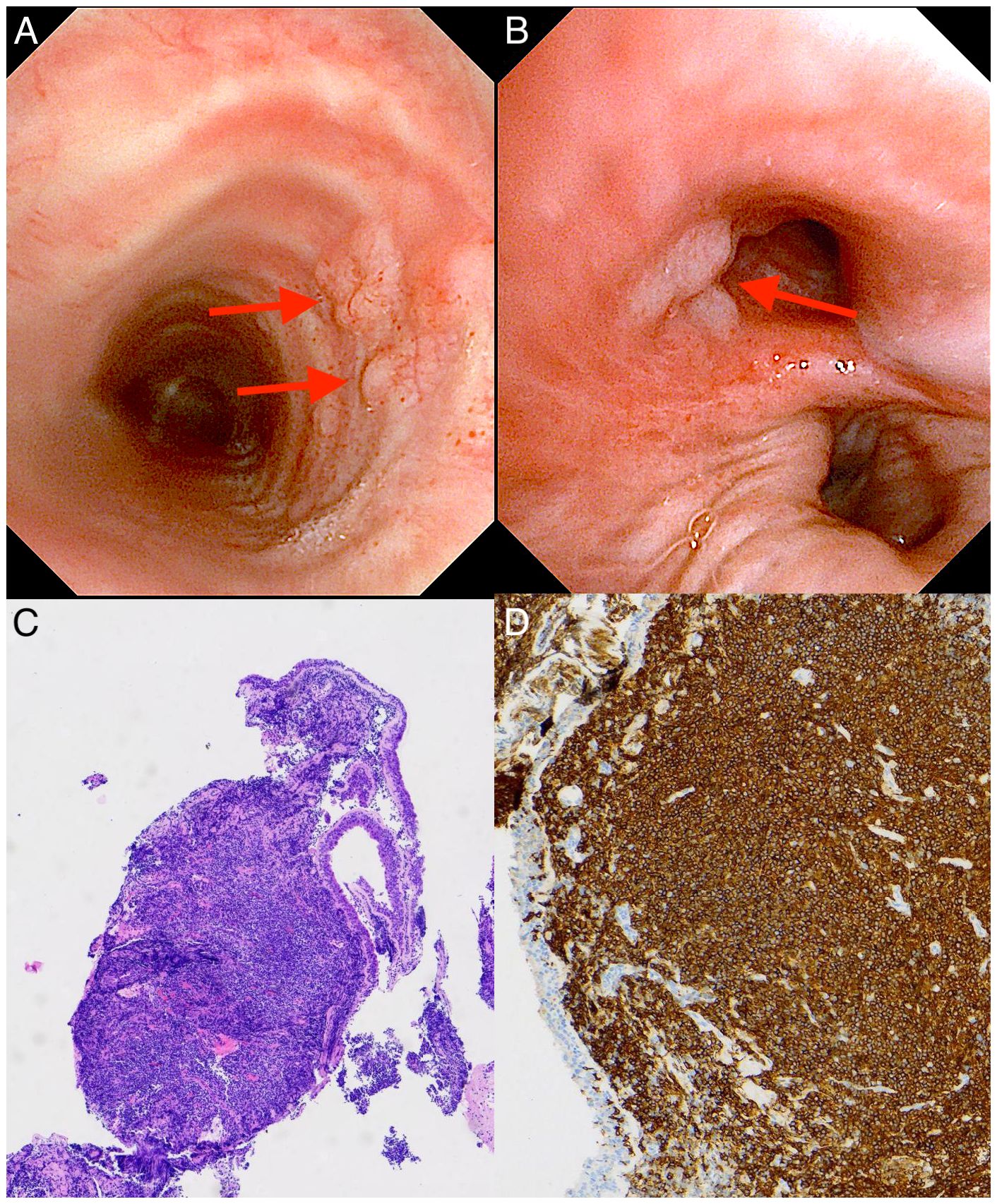 Endoscopic images and histological slides depicting pulmonary lymphangitic spread of cancer. Panel A and B show bronchial wall thickening and irregular mucosa in the airways marked with arrows. Panel C presents a histological section stained with hematoxylin and eosin, indicating dense cellular infiltration. Panel D shows immunohistochemical staining with a brown marker, highlighting tumor cell infiltration in the lung tissue.