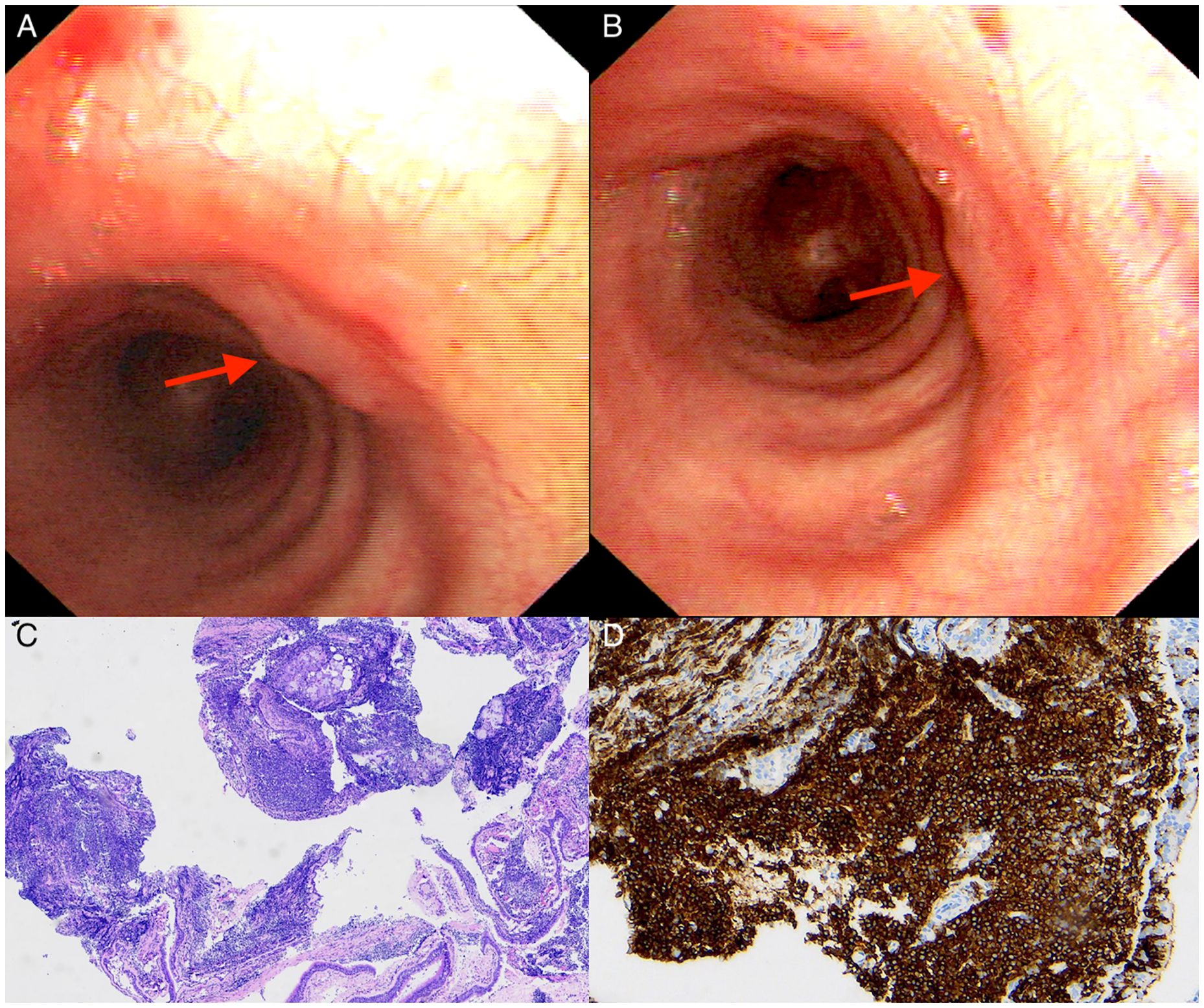 Panels A and B show endoscopic views of an esophageal mass highlighted by red arrows. Panels C and D display histological images; C shows tissue with blue staining, while D shows stained tissue with brown areas indicating immunohistochemical reactions.