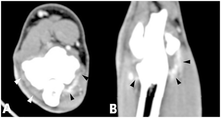 CT scan images labeled A and B. Image A is an axial view showing a bright area with arrowheads pointing to its boundaries within the tissue. Image B is a coronal view with similar bright areas and arrowheads indicating the borders.