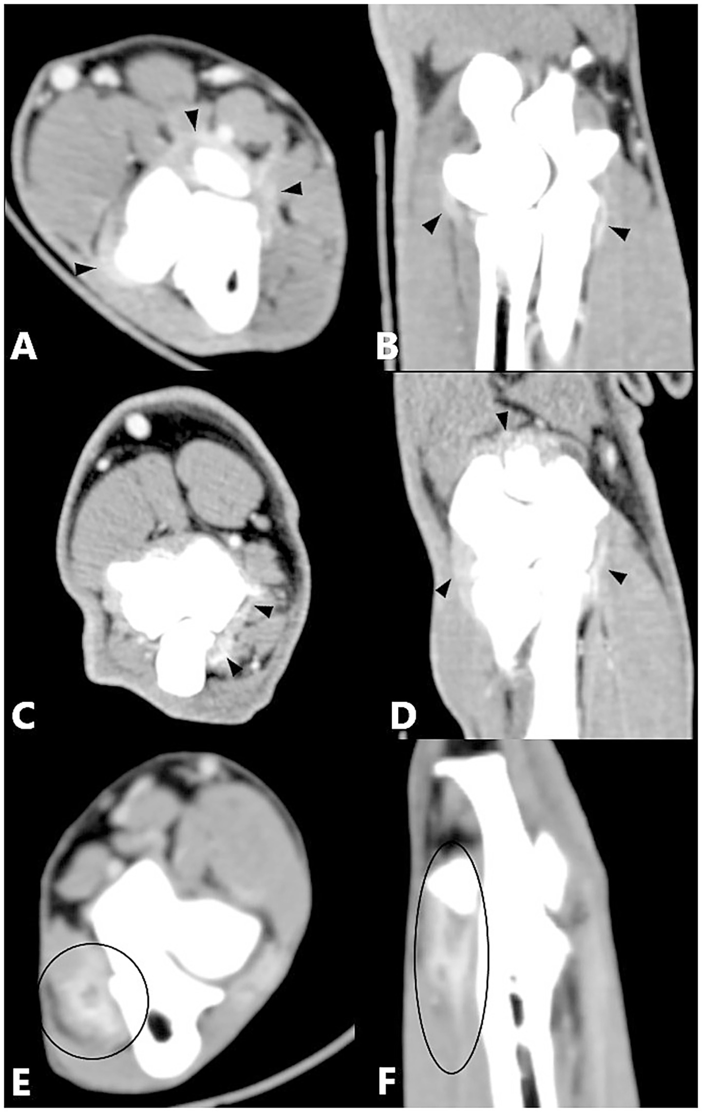 CT scan images labeled A to F show different cross-sections and planes of a medical condition. Black arrowheads point to specific areas in images A to D, highlighting significant features or abnormalities. Images E and F have areas circled in black, indicating regions of interest for further diagnostic evaluation.