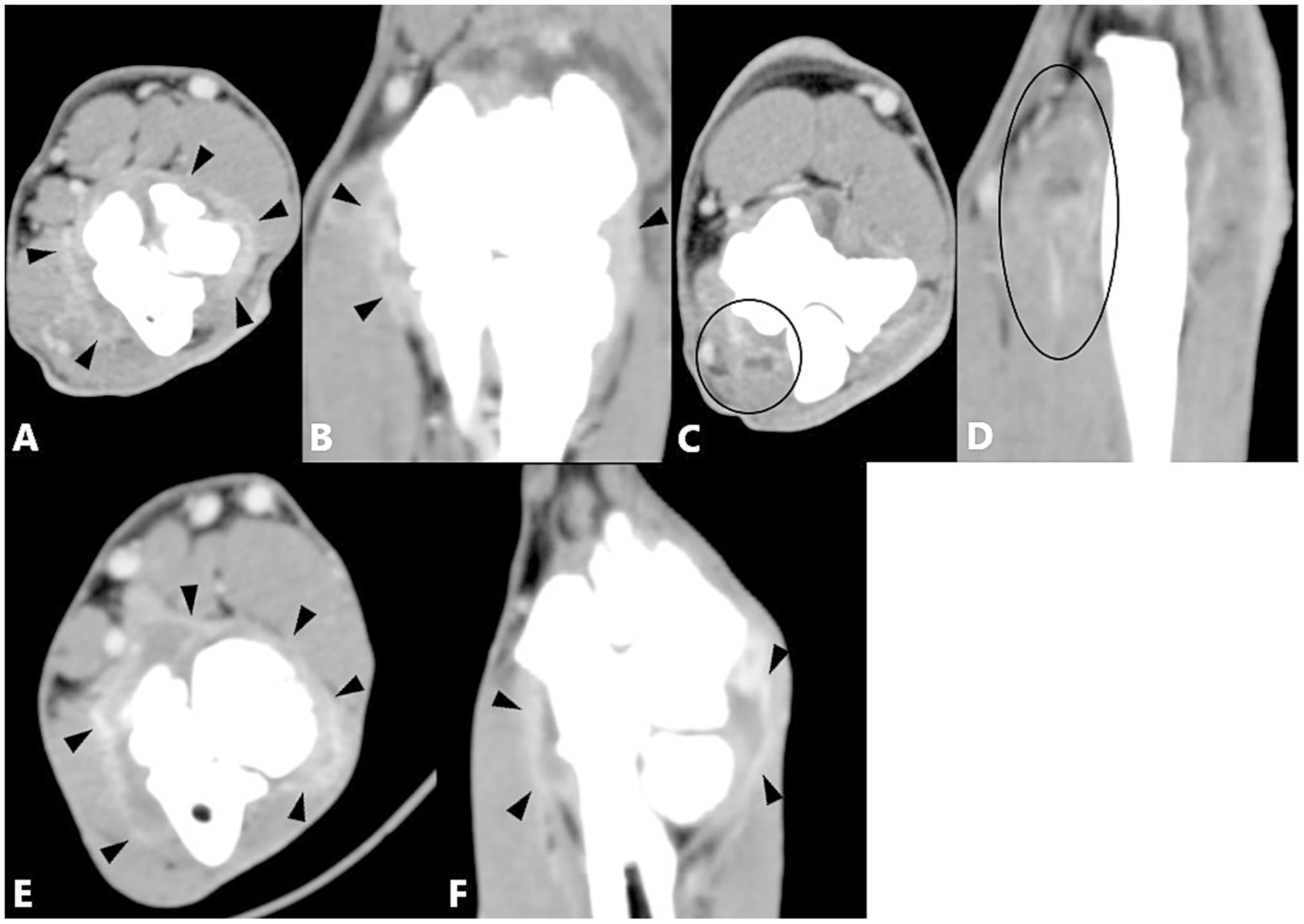 CT images in multiple sections (A-F) show a high-density, irregular mass within soft tissue, highlighted by arrowheads and circles. Different orientations point to areas of interest, indicating possible abnormalities or conditions.