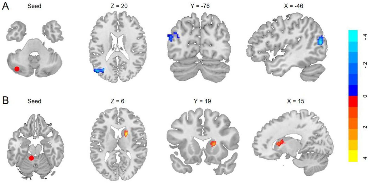 Brain imaging results with two series labeled A and B. Each series shows a seed region marked by a red dot. In series A, three brain views display blue highlighted areas along axes Z = 20, Y = -76, and X = -46. In series B, highlighted areas are in red and yellow along axes Z = 6, Y = 19, and X = 15. A color bar on the right ranges from blue (-4) to red (4).
