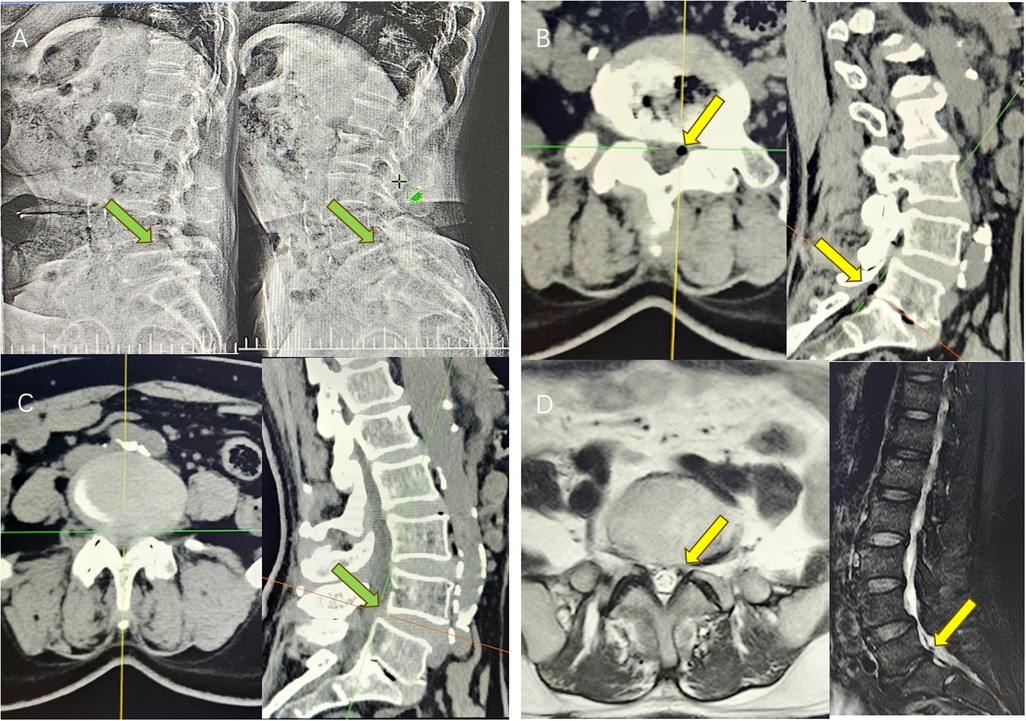 CT and MRI images showing the lumbar spine, with arrows indicating specific anatomical features and areas of interest. Panel A highlights regions with green arrows. Panel B and D use yellow arrows to point out certain structures in both cross-sectional and sagittal views. Panel C shows additional spine and soft tissue detail, also marked by arrows.