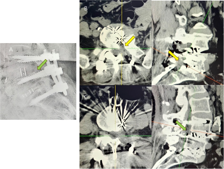 X-ray and CT scan images of a spine showing various angles. Image A depicts implanted screws and rods in the lumbar region with a green arrow pointing to a screw. Images B and C display cross-sectional views of the spine with yellow arrows highlighting specific areas of interest related to the screws.