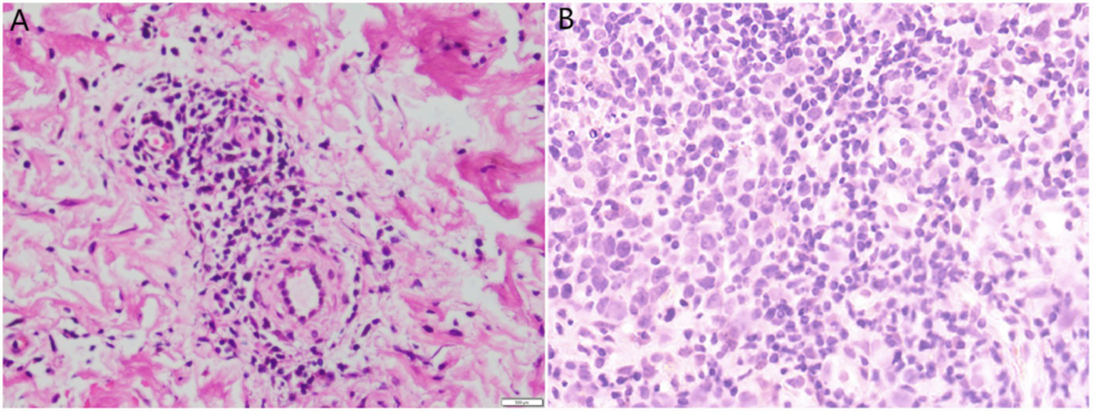 Panel A shows a histological image with dense connective tissue and a cluster of dark-staining cells. Panel B depicts a higher density of evenly distributed dark-staining cells, indicating more cellular tissue. Both images are stained to highlight cellular structures.