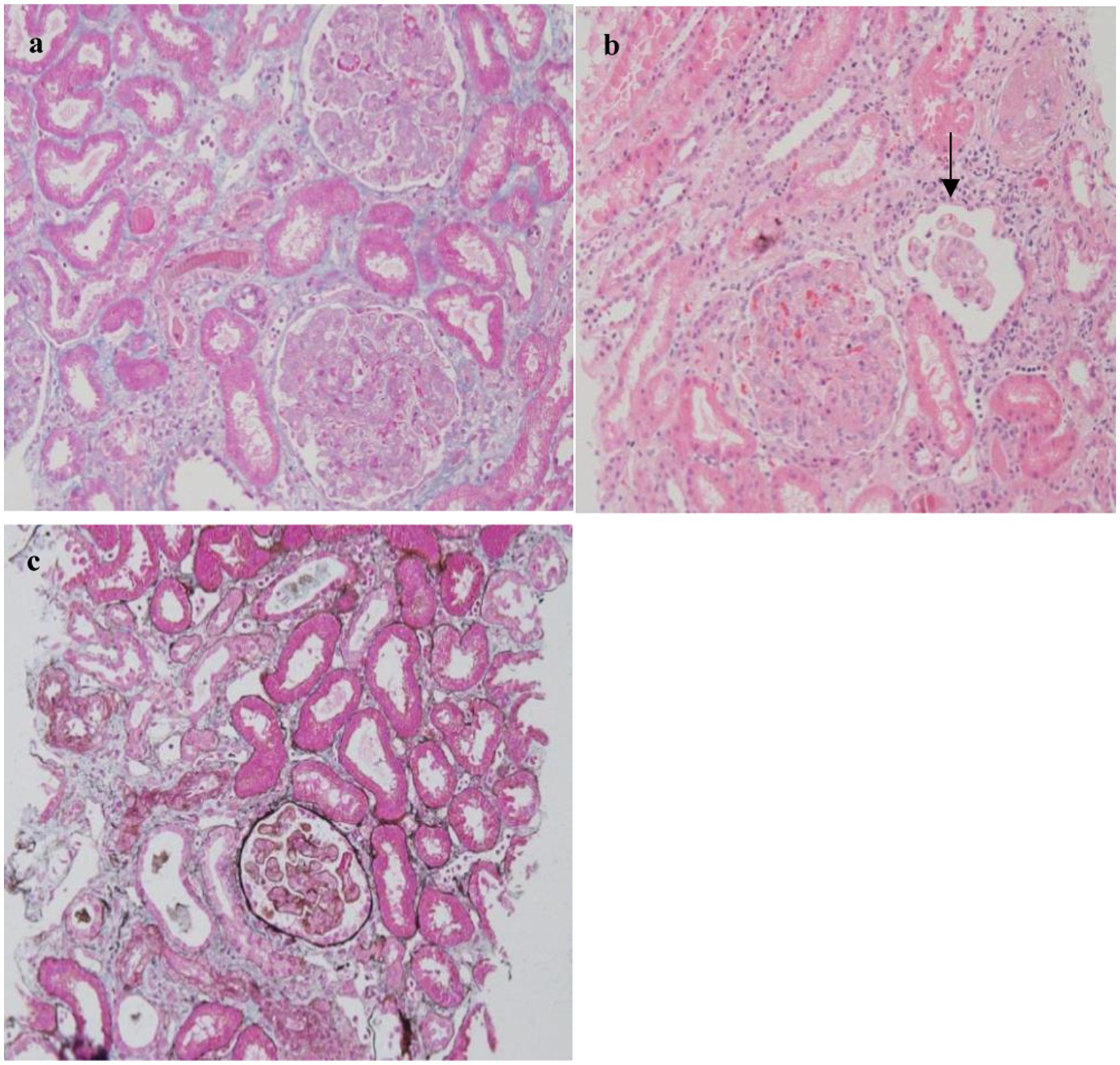 Histological images of renal tissue with PAS staining show different pathological features. Image a shows glomeruli with diffuse mesangial matrix expansion. Image b presents tubular atrophy with an arrow indicating pathology. Image c displays thickened tubular basement membranes.