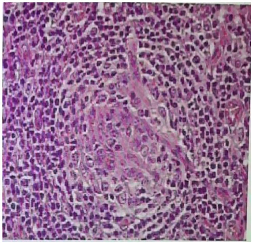 Microscopic image showing a section of lymphoid tissue with dense clusters of purple-stained cells surrounding a lighter central area. The arrangement suggests a follicular structure, typical of lymphoid tissues.