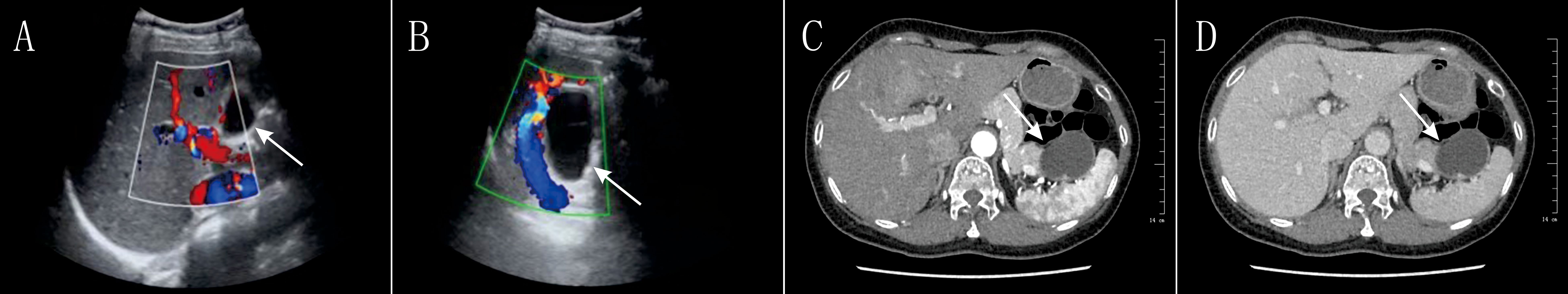 Ultrasound and CT images labeled A to D show detailed abdominal scans. Image A highlights blood flow with color Doppler, and an arrow points to a specific area. Image B also uses Doppler to show a different angle with an arrow indicating a feature. Images C and D are CT scans showing cross-sectional views of abdominal organs, both marked with arrows pointing to notable areas.