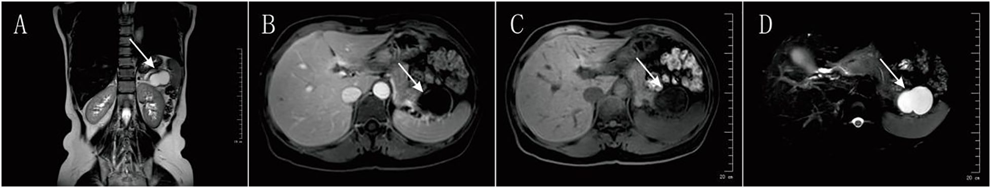 MRI scans of the abdomen labeled E, F, G, and H show various perspectives. Each image features an arrow pointing to a specific area, likely indicating an abnormality or area of interest. The scans display different views of internal organs and structures, highlighting a circular area in each image.
