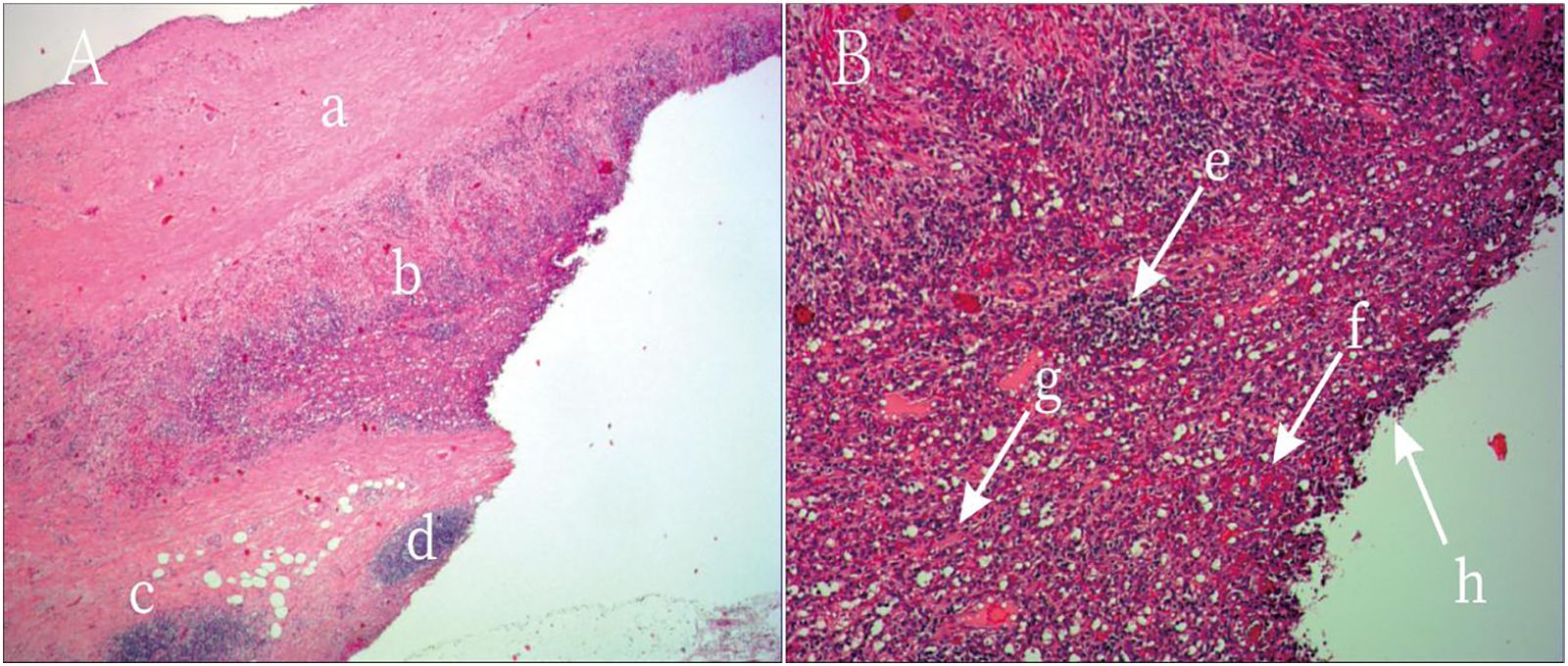 Two histological slides are shown side by side. The left slide is labeled with letters a to d, showing various tissue densities and structures with a primarily pink and purple stain. The right slide is labeled e to h, displaying a denser cellular pattern with arrows pointing to specific areas, indicating different tissue components or reactions. Both images highlight detailed cellular structures under a microscope.