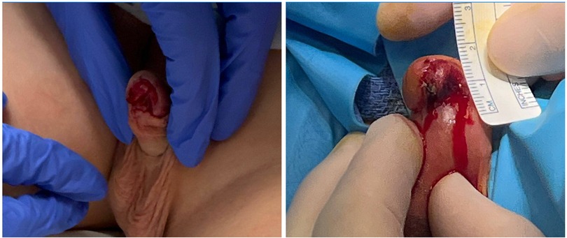Preoperative clinical photographs of a pediatric patient presenting with penile trauma resulting in partial avulsion of the ventral glans. Panel A shows a close-up view of the exposed glanular tissue at initial presentation. Panel B depicts intraoperative images taken under anesthesia, revealing more extensive tissue disruption with active bleeding and no urethral involvement. A measurement scale is included for reference during clinical documentation. These images represent a traumatic injury, NOT a complication of circumcision.