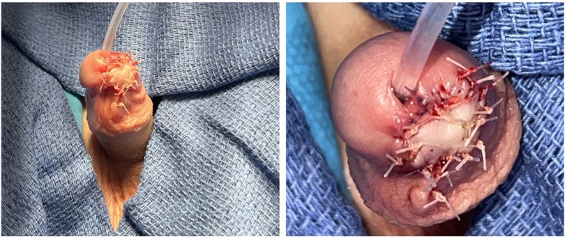 Immediate postoperative images showing the appearance of the glans following reimplantation and grafting of the avulsed tissue, approximately six hours after the traumatic injury. The left panel shows the glans with visible sutures along the repair site. The right panel presents a different angle, with additional sutures and a drainage catheter visible, all placed on surgical drapes.