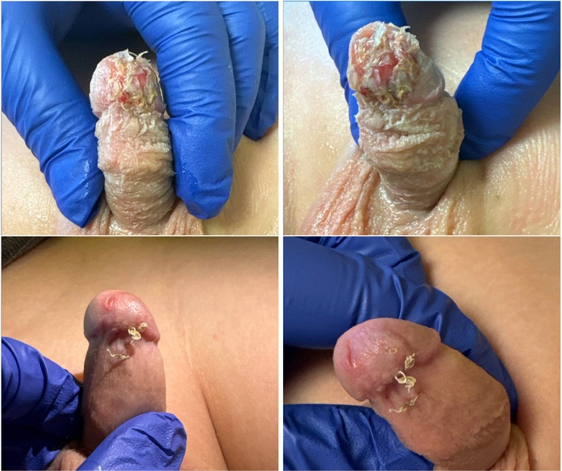 Postoperative images showing the appearance of the penis five weeks after successful reimplantation and hyperbaric oxygen therapy. The images demonstrate healed glanular tissue with minimal scarring and good cosmetic outcome. The penis is gently manipulated by gloved hands to show different views of the graft integration and surface healing.