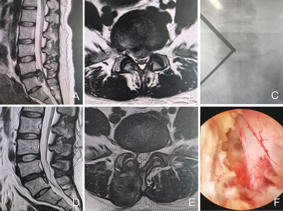 MRI and endoscopic images display spinal anatomy and procedures. Image A shows a sagittal view of the spine; B, a transverse spine section; C, fluoroscopic guidance in spinal intervention; D and E, different sagittal and transverse postoperative MRI views; F, a close-up endoscopic view of spine tissue.
