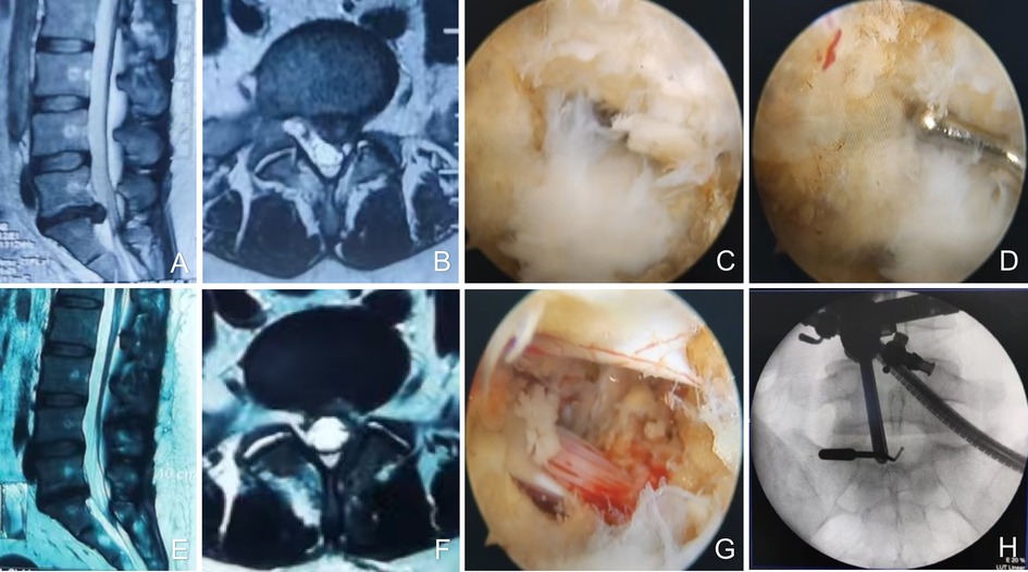 MRI and medical images are divided into sections labeled A to H. A and B show spinal MRI scans in sagittal and axial views. C and D depict endoscopic views of the spine with tissue and tools visible. E and F different sagittal and transverse postoperative MRI views. G a close-up endoscopic view of spine tissue. H is a fluoroscopic image displaying surgical instruments in position.
