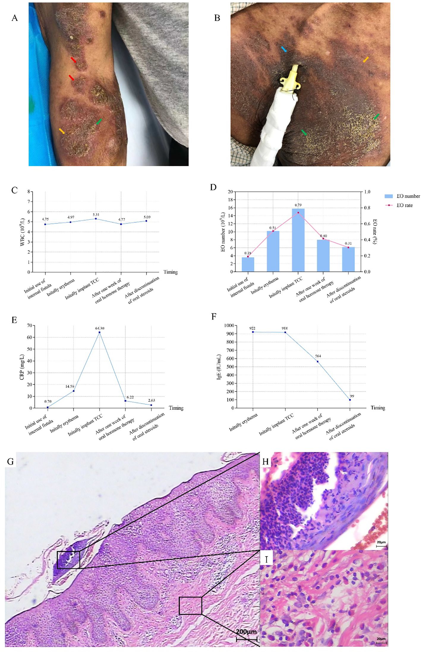 A composite image shows various medical visuals. Panel A displays a patient's leg with lesions marked by red, green, and orange arrows. Panel B shows a patient's back with lesions and an inserted medical device, highlighted by blue, green, and orange arrows. Panels C, D, E, and F show line graphs depicting WBC count, eosinophil number and rate, CRP levels, and IgE levels over time, respectively. Panel G shows a microscopic view of skin tissue with marked sections. Panels H and I are close-ups of these sections, highlighting cellular details.