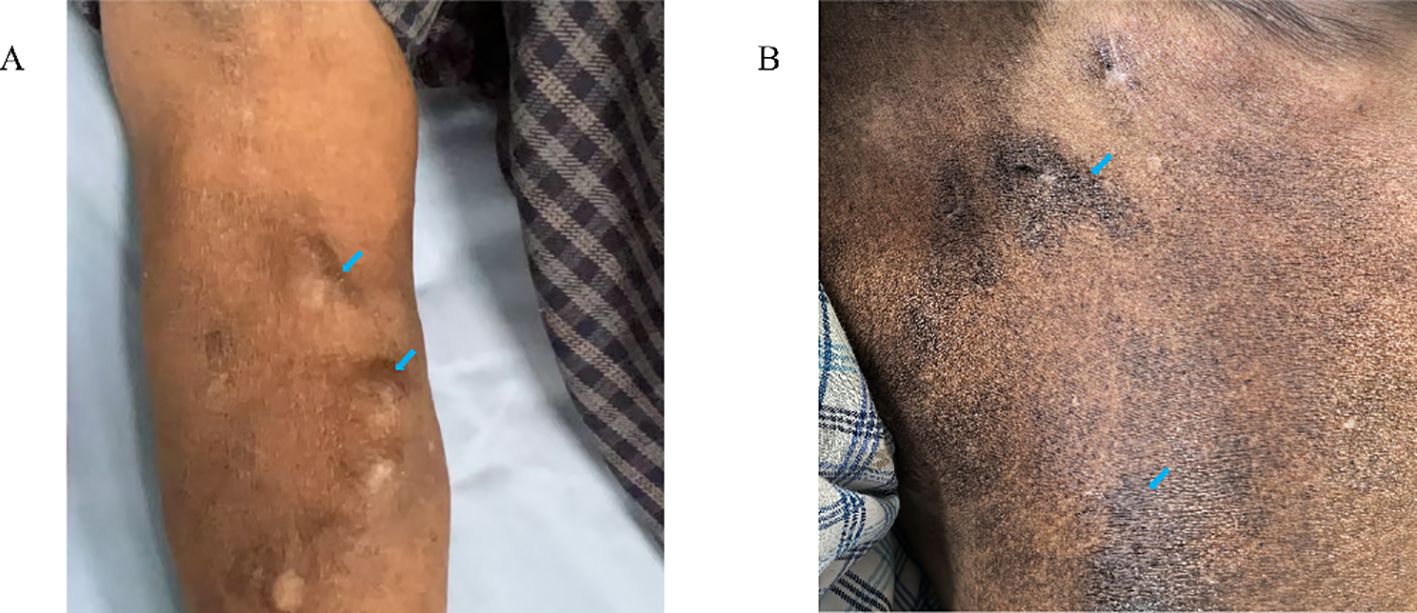 Two images labeled A and B showing skin conditions. Image A depicts an arm with patches of hypopigmented skin among dark areas, with blue arrows indicating specific spots. Image B shows a close-up of a similar condition on a person's neck, with blue arrows highlighting two areas.