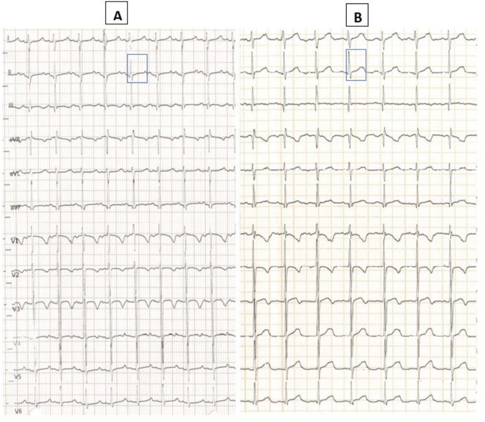 Side-by-side ECG graphs labeled A and B. Both graphs show heart rhythm tracings with a highlighted segment in each using a blue rectangle. Each graph displays multiple lead recordings with pattern variations indicating potential differences in cardiac activity.