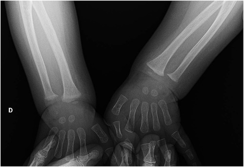 X-ray of two forearms and hands, displaying the bones clearly. The radius and ulna are visible in both forearms, with distinct details of the carpal, metacarpal, and phalangeal bones in the hands.