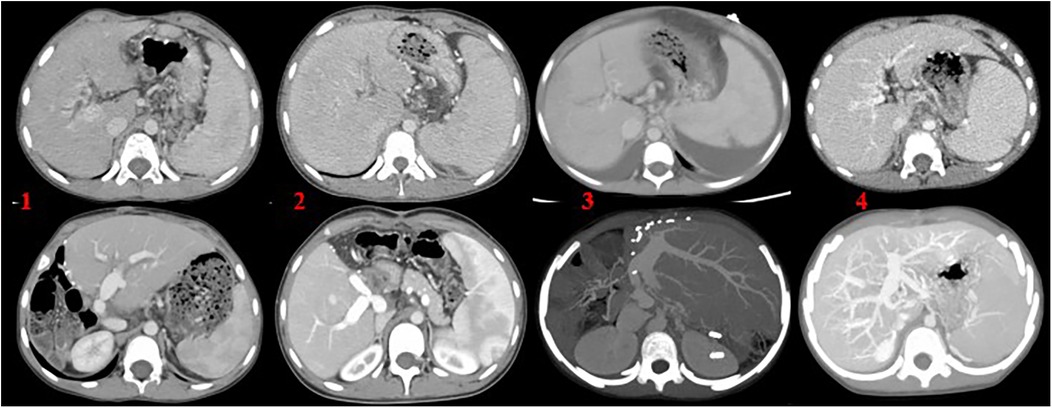 Four panels of CT scans displaying transverse abdominal cross-sections are labeled one to four. Each image shows variations in the visibility of internal structures and differences in density.