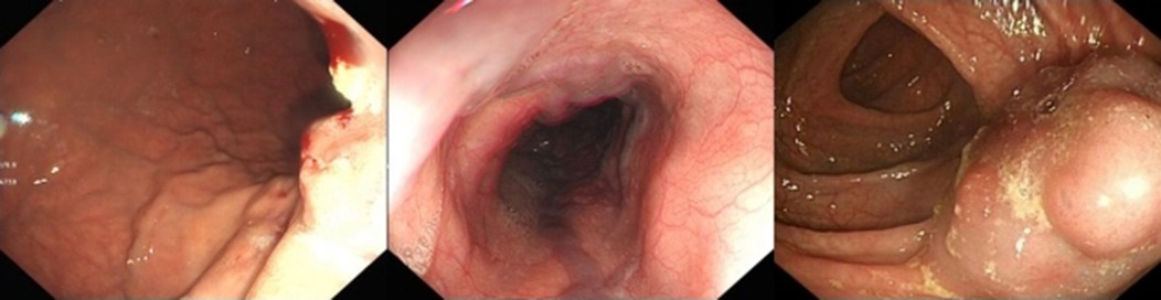 Panels A, B, and C show endoscopic images. Panel A displays the esophagus with visible blood vessels. Panel B shows the esophagus with normal vascularity. Panel C features part of the esophagus and stomach, with a noticeable polyp.