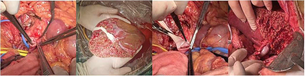The surgical procedure shows a liver in an open abdominal cavity. Medical instruments and gloved hands are visible handling the liver, which appears red and textured. The surrounding tissue is exposed, with visible blood and surgical tools. Thrombus is visible inside the portal vein, the allogeneic vascular graft is clearly seen, and the portal vein appears filled.