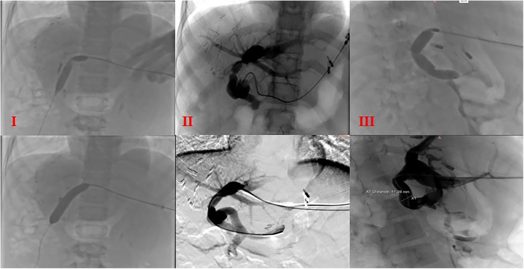 A series of six fluoroscopic images showing a medical procedure involving contrast agents. Panels I to III depict stages of catheter insertion and imaging of blood vessels. Structures and instruments are visible with varying levels of contrast.