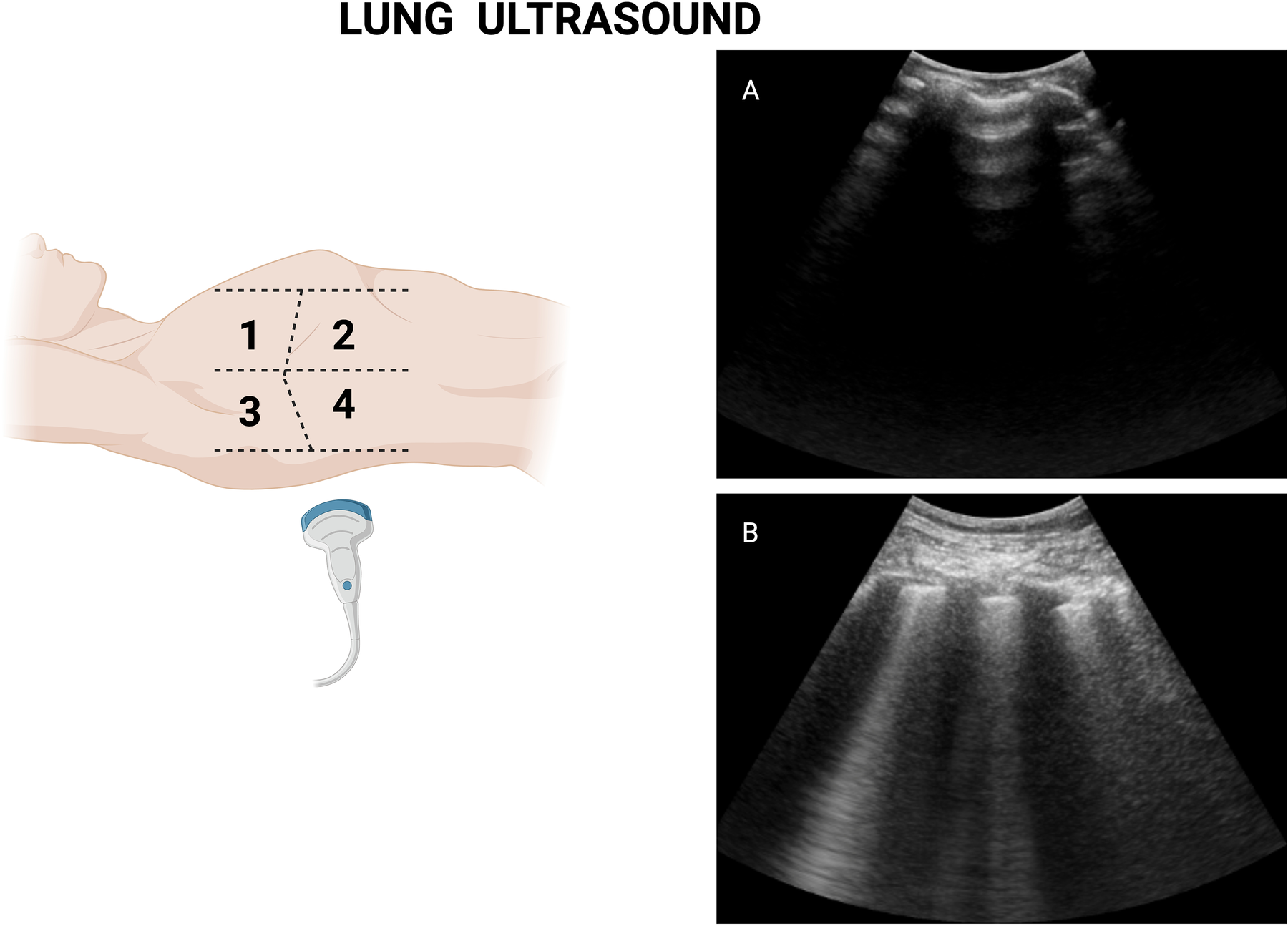 Lung ultrasound image showing an illustration of a person's side marked with four quadrants labeled one to four, indicating potential probe positions. On the right, there are two ultrasound images labeled A and B. Image A shows vertical, parallel lines suggesting normal lung sliding, while Image B shows vertical lines with comet-tail artifacts, indicating lung congestion.