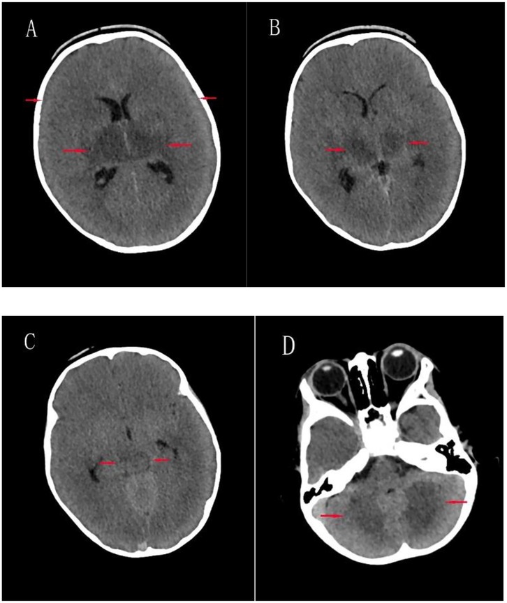 Four-panel CT scans labeled A to D show cross-sections of a brain with red arrows indicating areas of interest. Panel A highlights the lateral ventricles, Panel B has arrows pointing to the thalamus, Panel C highlights the areas near the lateral ventricles, and Panel D shows the cerebellum and eyes. Each scan emphasizes different anatomical features.\n\n
