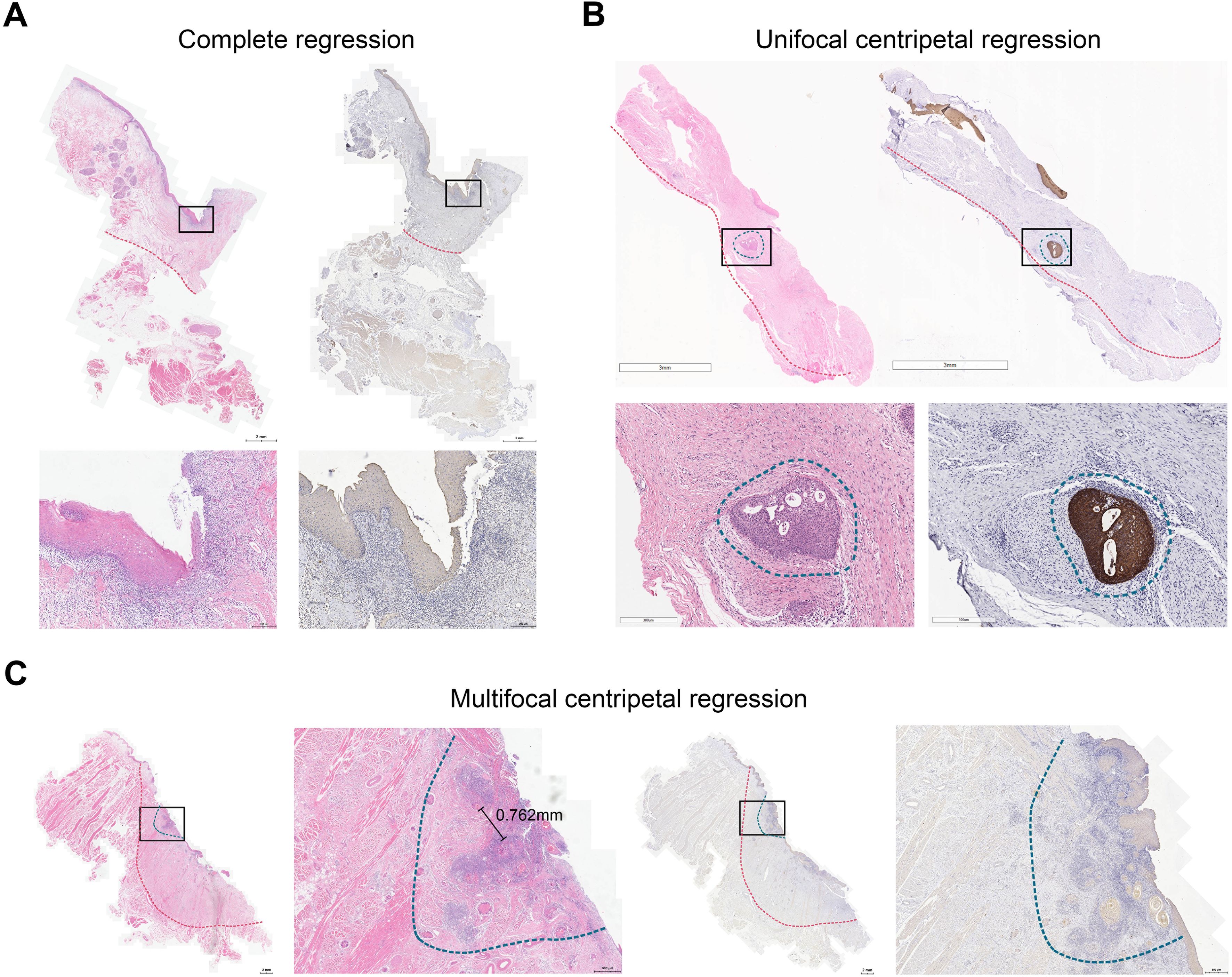 Labeled pathology slides show three types of skin cancer regression. A: Complete regression with two magnified areas showing detailed tissue structure. B: Unifocal centripetal regression with outlined focal areas, highlighting a specific region. C: Multifocal centripetal regression showing multiple focal regions with one measurement of 0.762 mm. Each section exhibits different tissue staining to indicate varying levels of regression.