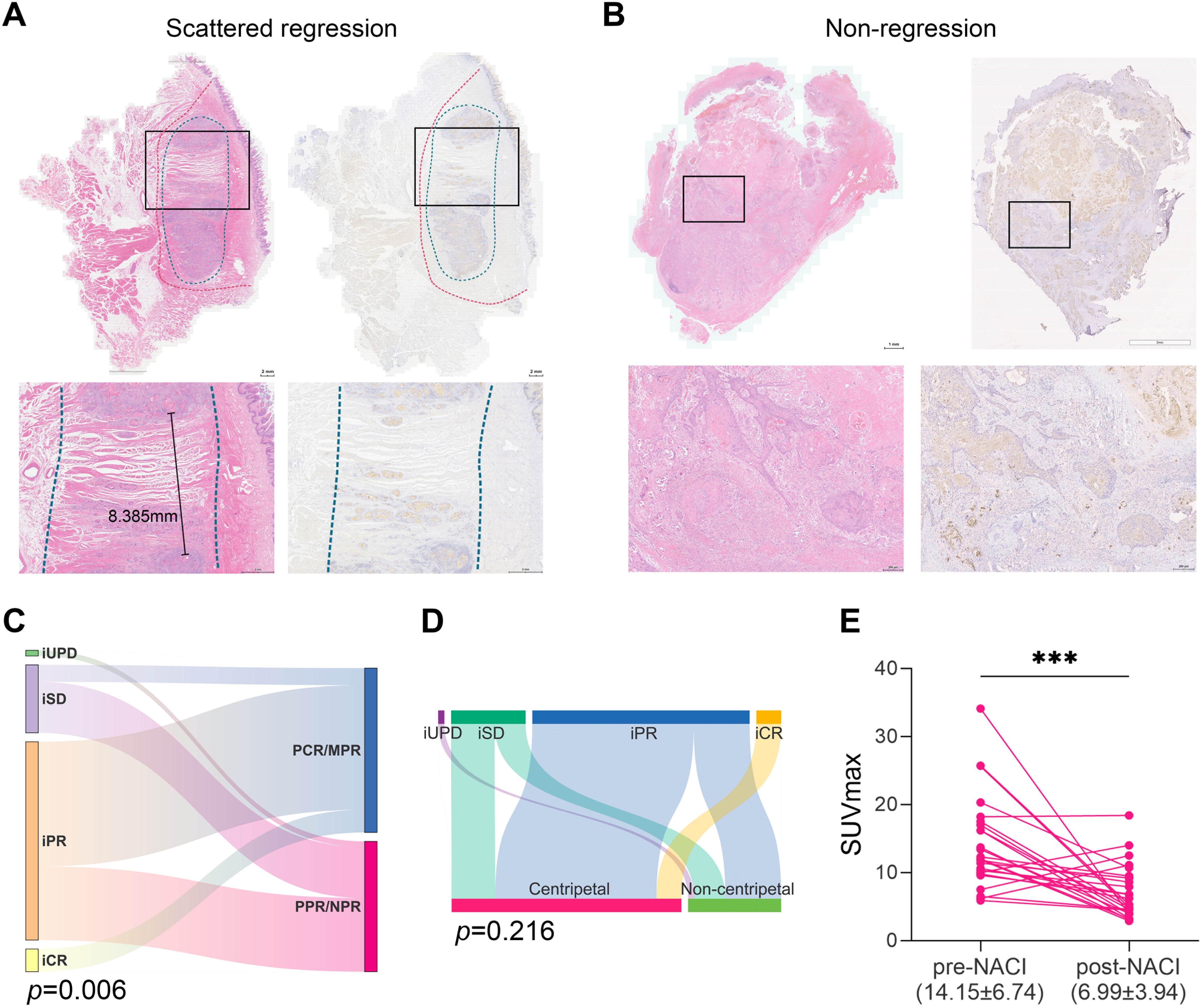 Panel A shows images of tissue with scattered regression, highlighting a measurement of 8.385 millimeters. Panel B depicts non-regression tissue samples. Panel C presents a flow diagram with iUPD, iSD, iPR, and iCR categories, showing a p-value of 0.006. Panel D is another flow diagram comparing centripetal and non-centripetal with a p-value of 0.216. Panel E is a line graph illustrating SUVmax values from pre-NACI to post-NACI, with a significant decrease noted at 14.15±6.74 to 6.99±3.94.