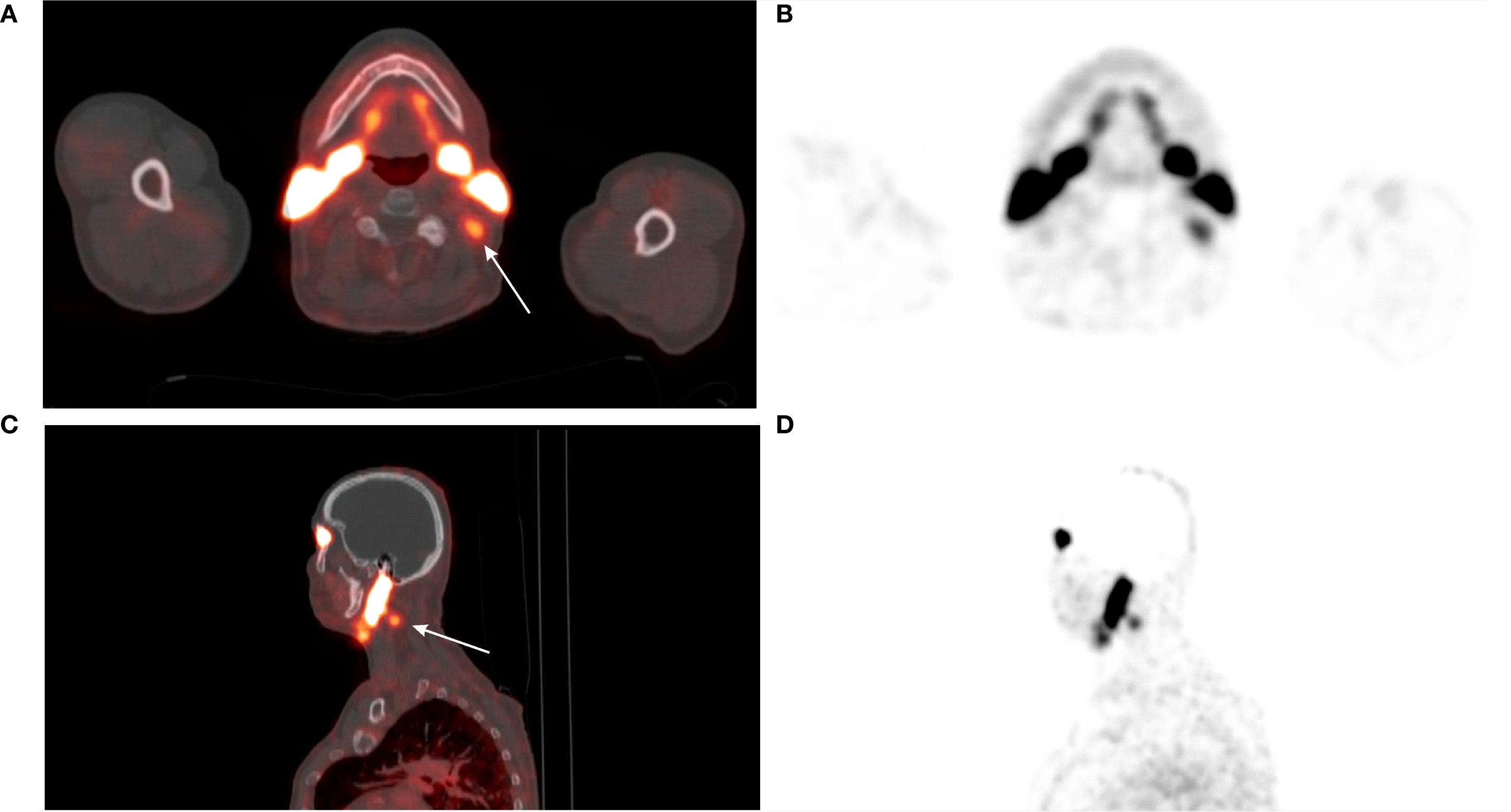 Four-panel medical image featuring PET-CT scans. Panel A shows a horizontal cross-section of the neck with highlighted areas indicating metabolic activity. Panel B presents a black-and-white version of the same section. Panel C is a sagittal view highlighting areas of metabolic activity in the neck and chest. Panel D displays a black-and-white version of this sagittal view. Arrows indicate specific areas of interest.