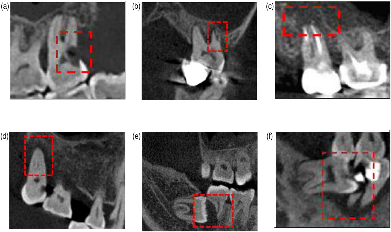 Six dental X-ray images labeled a through f, each highlighting different sections with red dashed rectangles. These sections focus on various teeth and jaw areas, possibly indicating dental issues or areas of interest for examination.