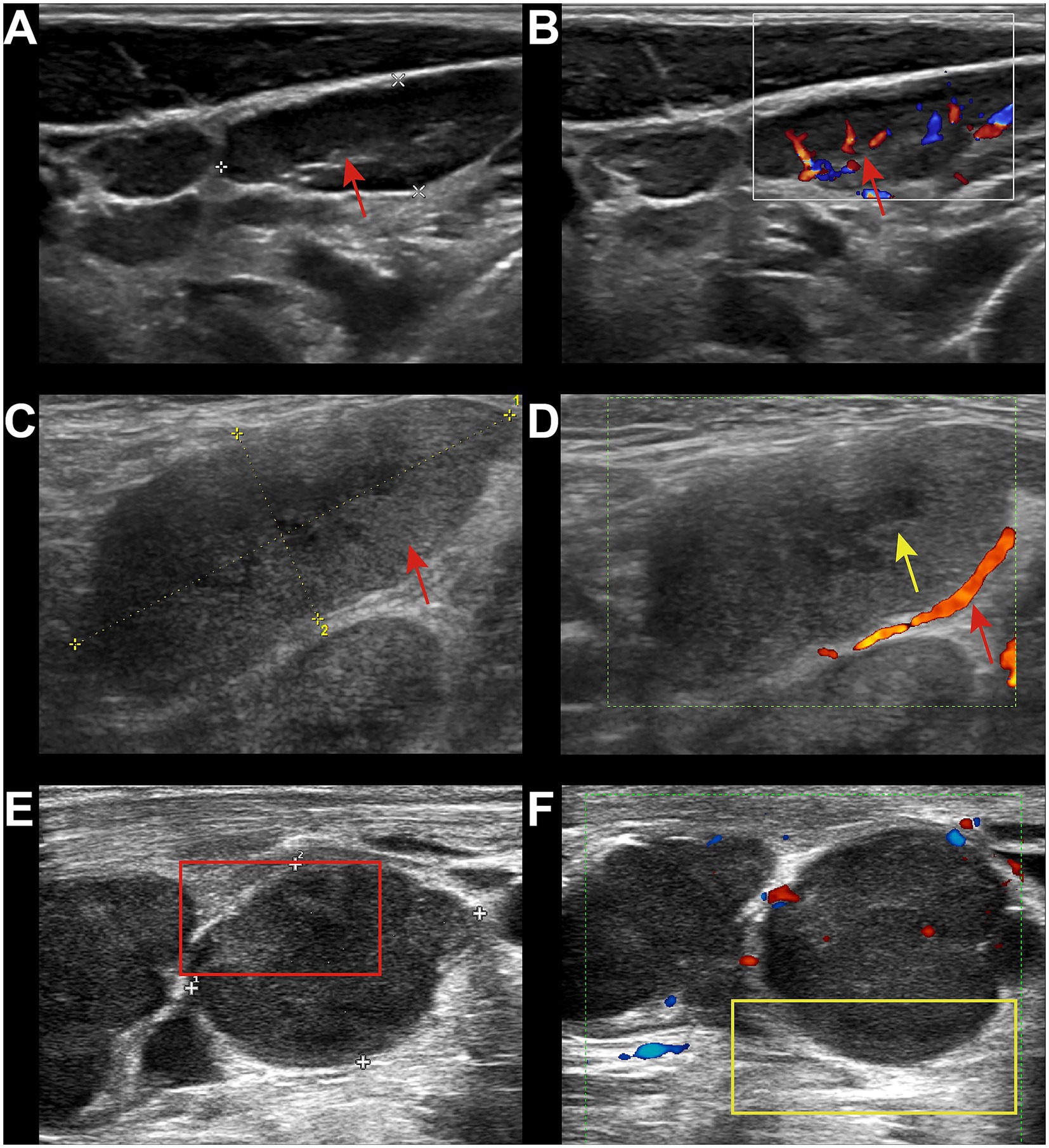 Ultrasound images labeled A to F. Image A shows a red arrow indicating a dark structure. Image B includes a color Doppler box with blue and red areas, highlighting blood flow. Image C shows a red arrow pointing towards a lesion with measurement markers. Image D has yellow and red arrows showing vascular structures with Doppler highlights. Image E contains a red box around a circular structure. Image F displays blue and red Doppler signals near circular structures within a yellow box.