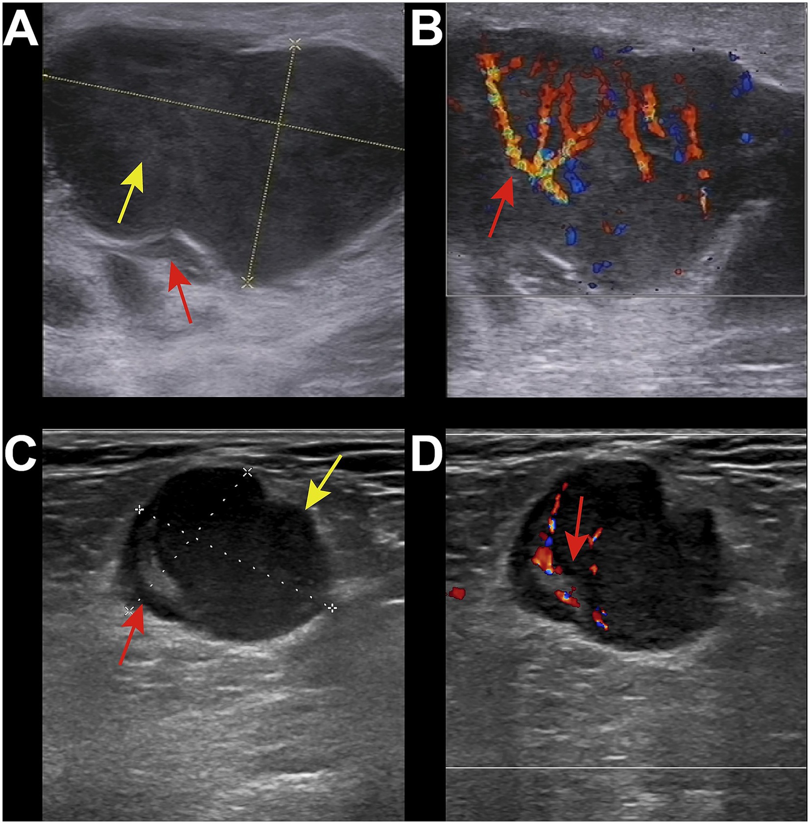 Ultrasound images labeled A to D show distinct anatomical features. Image A displays two arrows pointing to different areas within a structure, with dotted lines indicating measurements. Image B illustrates blood flow with red and blue color Doppler signals, marked by an arrow. Image C shows a circular structure with measurement lines and arrows identifying particular regions. Image D highlights internal features with color Doppler signals and an arrow pointing to key areas.