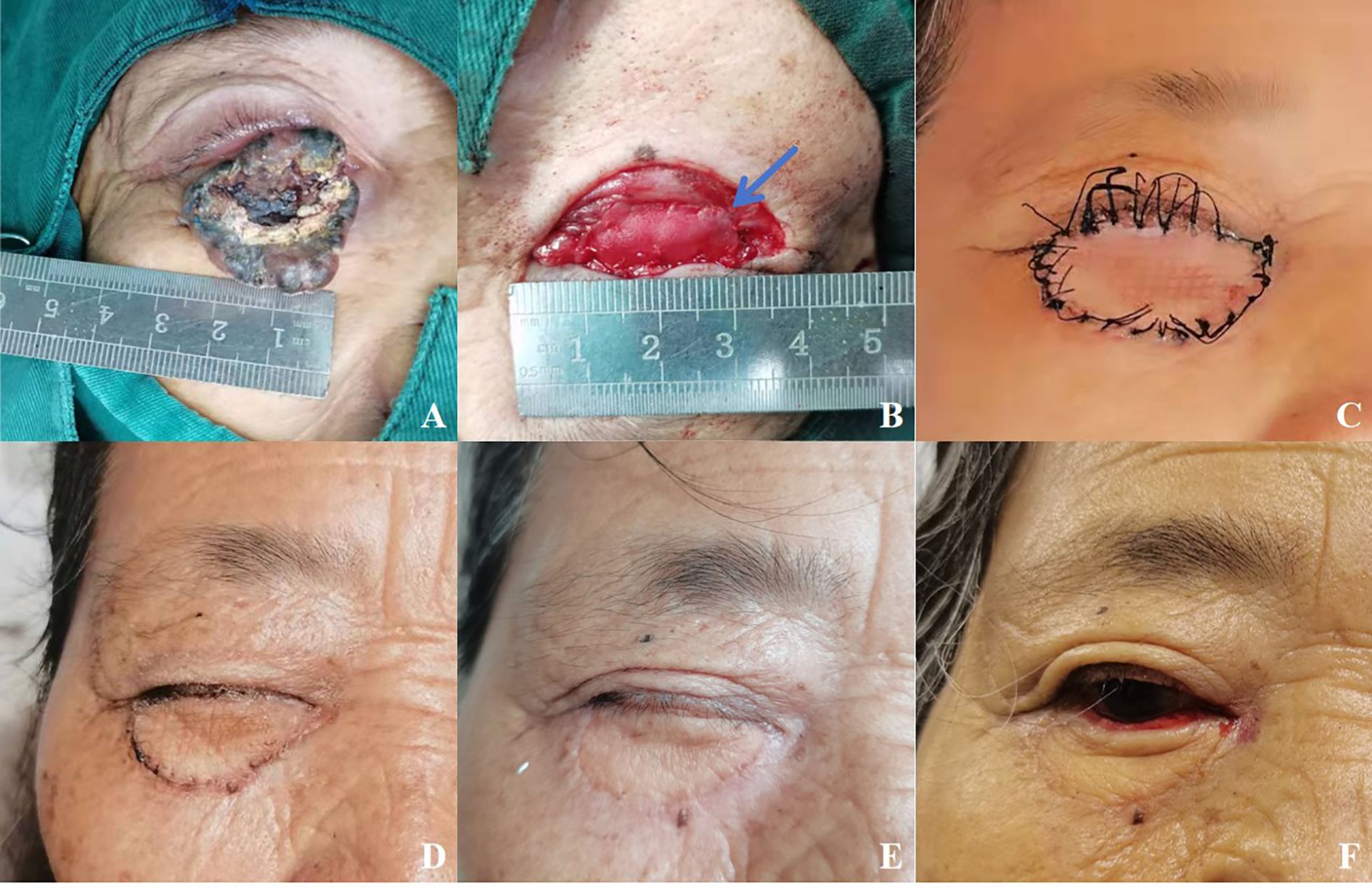 A series of six images labeled A to F shows the progression of a surgical procedure on an individual's eye area. Image A shows a lesion near the eye with a ruler for scale. Image B displays the area after lesion removal, marked with an arrow. Image C illustrates the site after stitches. Image D shows early healing with sutures still visible. Image E displays further healing with reduced swelling. Image F presents the final healed state with minimal visible scarring.