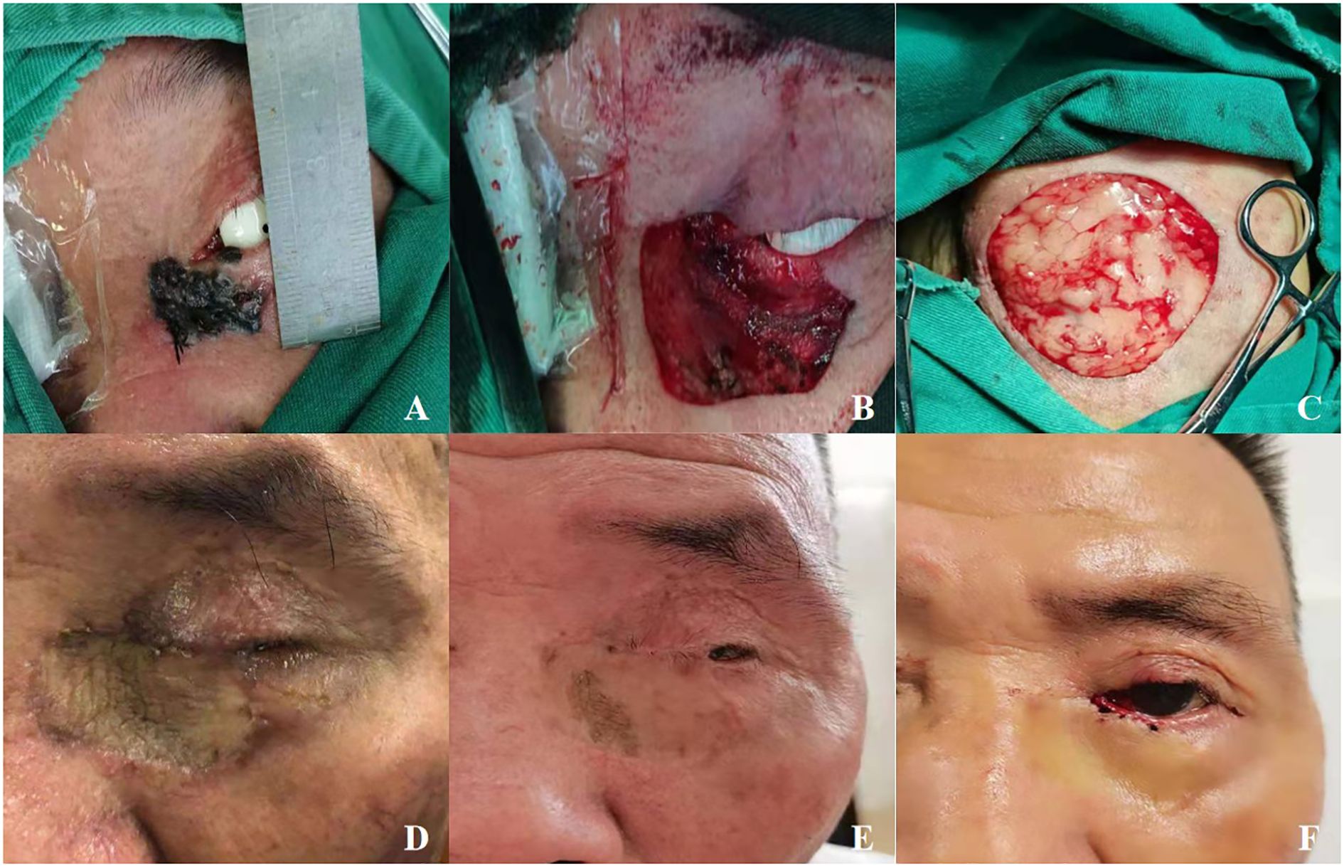 A series of six medical images showing facial reconstruction procedures. A and B depict pre-operative conditions with lesions near the eye. C shows a donor site being prepared for skin grafting. D, E, and F display the progressive stages of healing post-surgery, with improvements in skin texture and appearance around the eye and face.