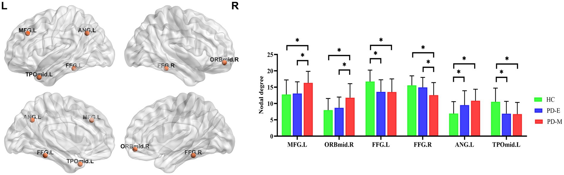 Four brain models show regions labeled MFG.L, ANG.L, FFG.L, TPOmid.L on the left, and FFG.R and ORBmid.R on the right. A bar chart compares nodal degrees across these regions for three groups: HC (green), PD-E (blue), and PD-M (red), with significant differences marked by asterisks.