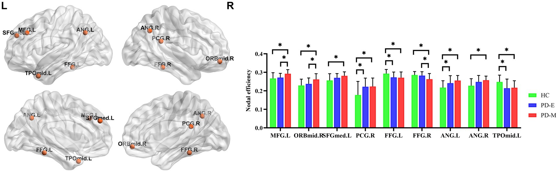 Brain models on the left highlight nodes such as SFGmed.L, MFG.L, ANG.L, and others with orange markers. On the right, a bar graph displays nodal efficiency across different brain regions. The bars, colored green (HC), blue (PD-E), and red (PD-M), show variations with significant differences marked by asterisks. Regions include MFGL, PCG.R, FFG.L, among others, with error bars indicating variability.