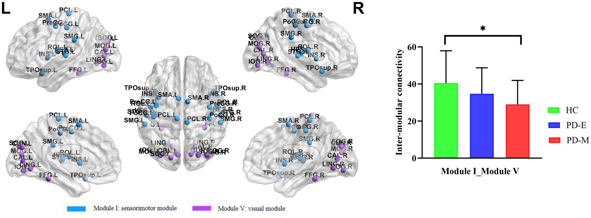 Brain diagrams showing sensorimotor and visual modules with nodes colored blue and purple. Adjacent bar graph shows inter-modular connectivity levels: HC (green) has higher connectivity compared to PD-E (blue) and PD-M (red), with a significant difference marked by an asterisk.