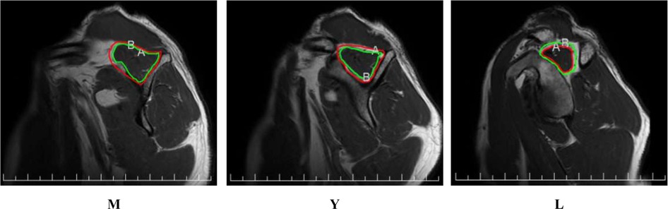 The entire supraspinatus muscle and the muscle portion are separately highlighted with circles. The green circle indicates the entire supraspinatus muscle, while the red circle indicates the muscle portion.