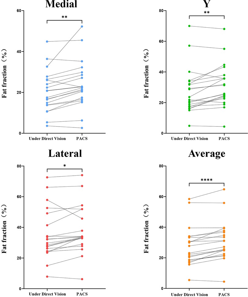 The paired t-test results for measurements obtained through direct visualization and using the PACS system. The blue bars represent the medial side, the green bars represent the Y-plane, the red bars represent the lateral side, and the orange bars represent the mean values. The asterisks indicate significant differences.