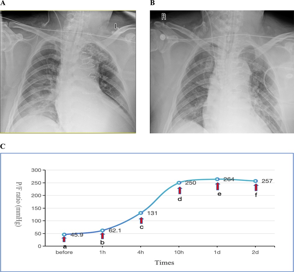 Chest X-ray images and a graph are shown. Image A and image B show a bilateral pulmonary infiltration.