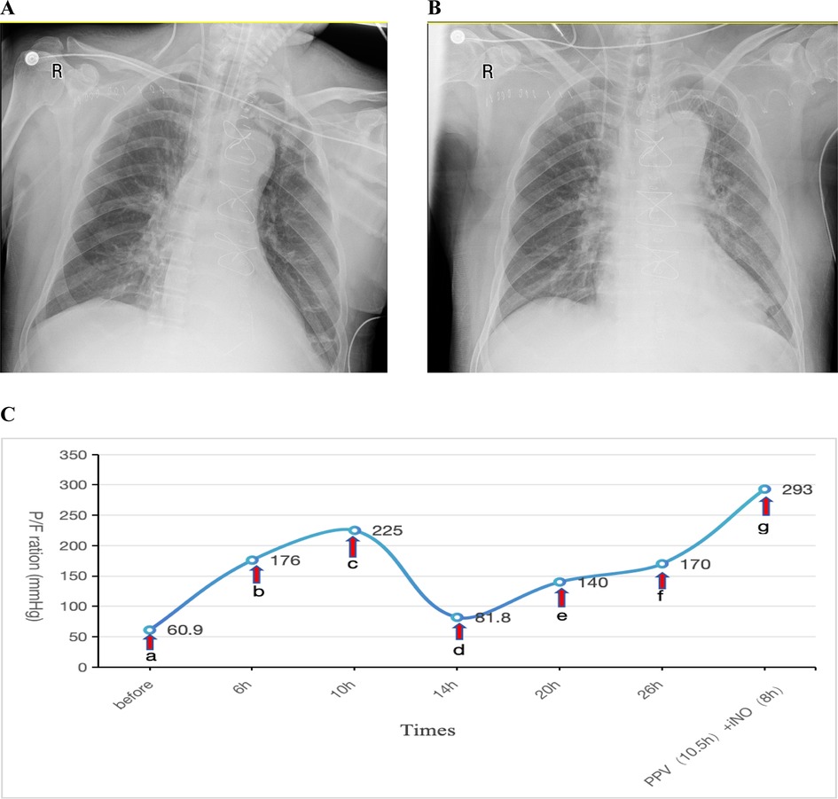 x-rays labeled A and B display a chest with medical devices in position. Image C is a line graph demonstrating the progression of P/F ratio (mmHg) over time, showing significant increases at specific intervals.