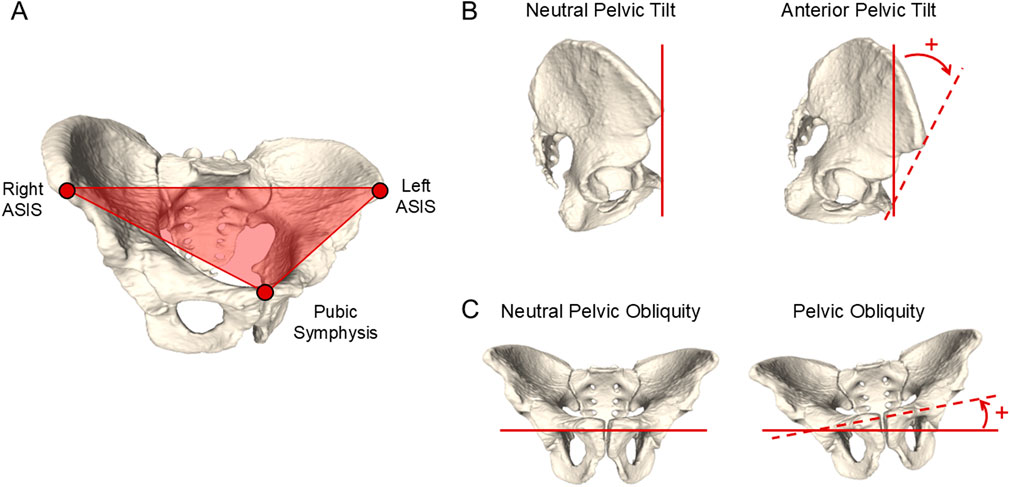 Diagram showing pelvic positions. A) Triangle defined by right and left anterior superior iliac spines (ASIS) and pubic symphysis. B) Side views of neutral and anterior pelvic tilt. C) Front views of neutral and oblique pelvic positions.