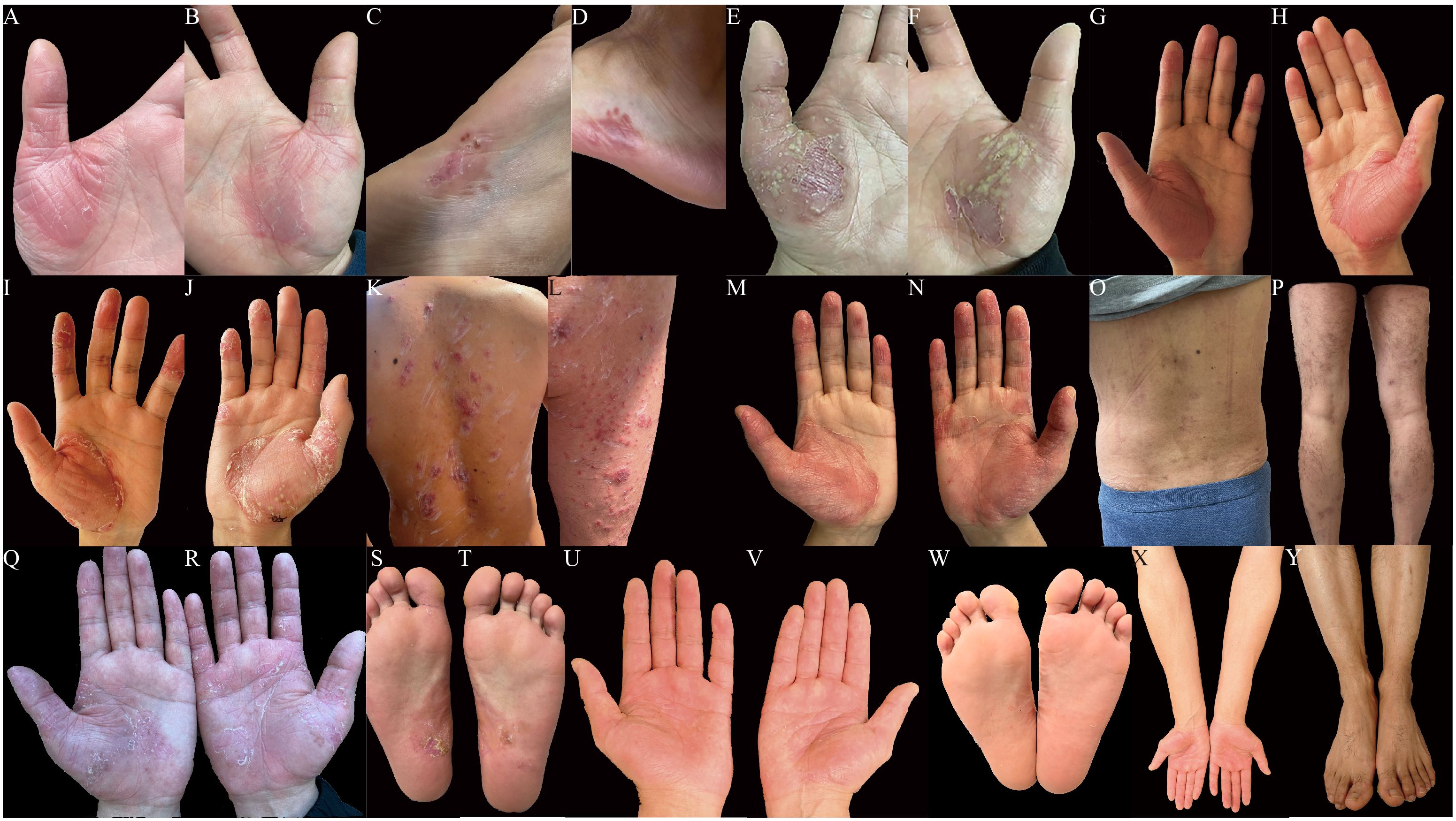 A collage of images showing skin conditions on various body parts, labeled A to Y. The images depict hands, feet, back, and legs with visible redness, peeling, rashes, and skin lesions. Some areas appear raw or inflamed, indicating potential dermatological issues. Each panel highlights different degrees and types of skin conditions, possibly related to eczema, psoriasis, or dermatitis. The skin tone varies throughout the images, adding context to the conditions displayed.