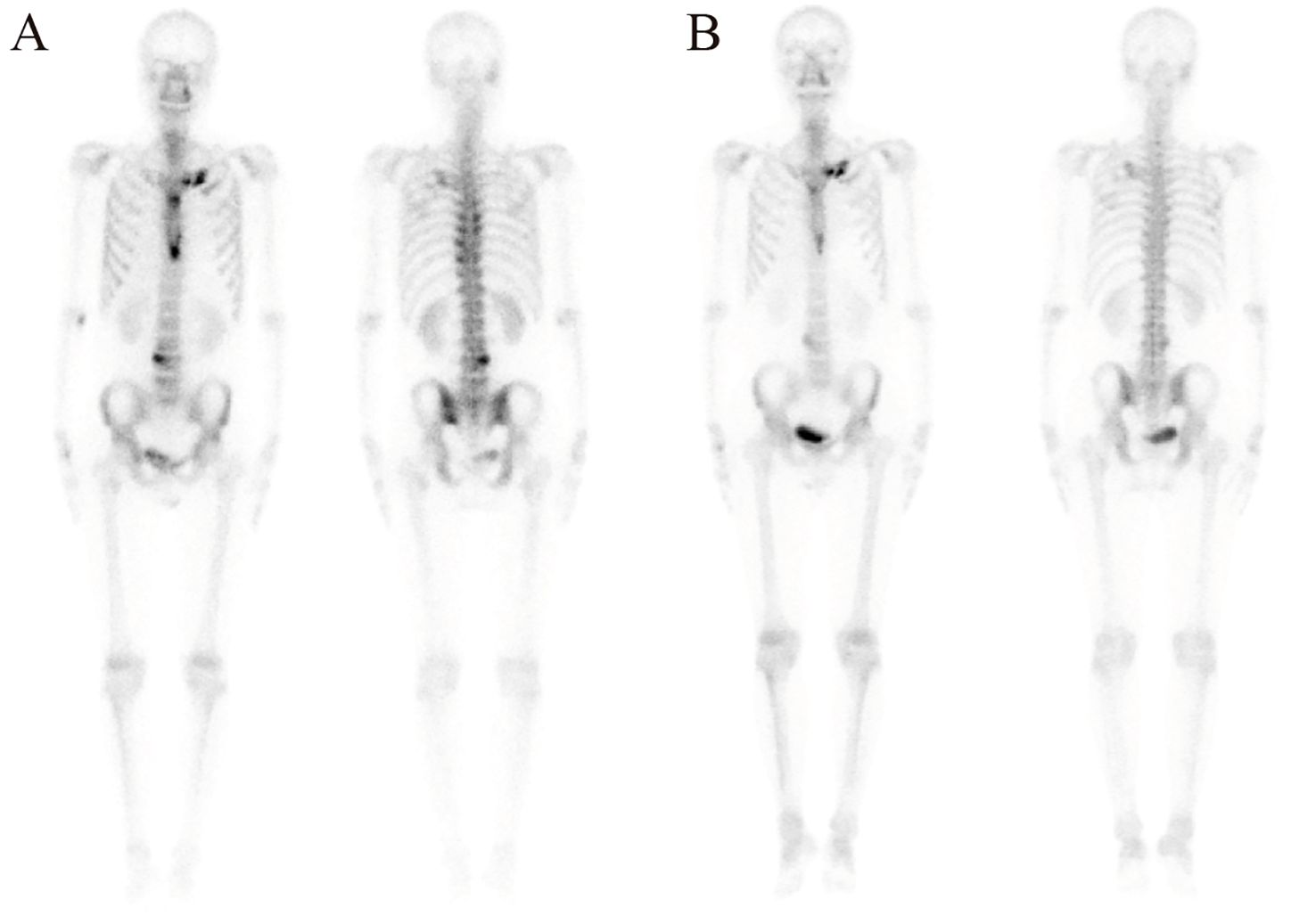 Four skeletal scans labeled A and B, showing anterior and posterior views. Scans reveal skeletal structure with varying degrees of intensity, highlighting key bones such as the skull, ribs, spine, pelvis, and limbs.