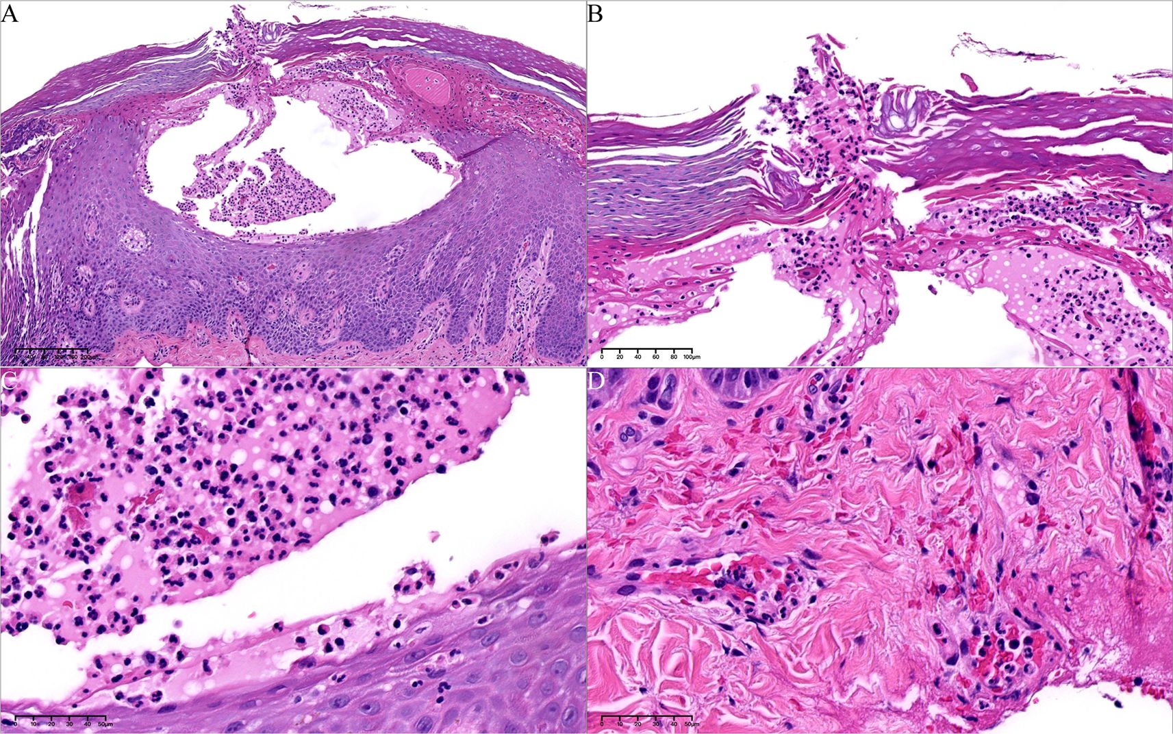 Histopathological images in four panels labeled A to D, showing different tissue sections stained with hematoxylin and eosin. Panel A shows a cross-section of a densely cellular tissue layer with a central lumen. Panel B highlights fibrous tissue with inflammatory cell infiltration. Panel C focuses on densely packed cells with visible nuclei. Panel D illustrates fibrous structures interspersed with inflammatory cells. All sections appear stained in shades of pink and purple, emphasizing cell and tissue morphology.
