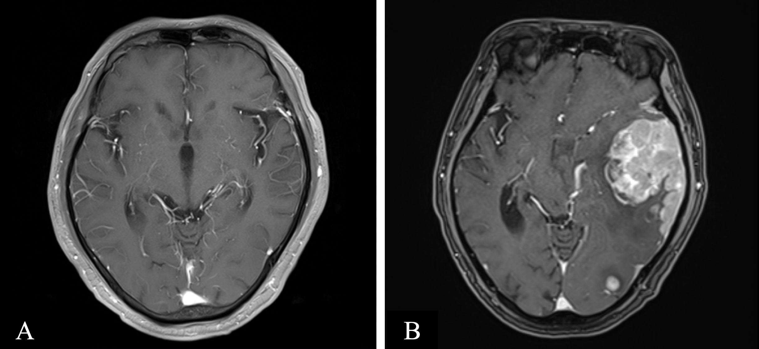 Two MRI scans show axial views of a brain. The left scan appears normal, while the right scan reveals a large, irregular, bright mass on the right side, suggesting a brain abnormality or tumor.